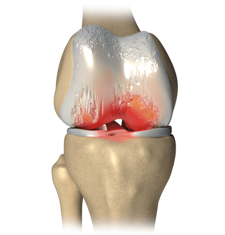 knee with osteoarthritis. Cartilage breakdown