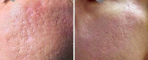 Before and After Acne Scar Laser Treatment